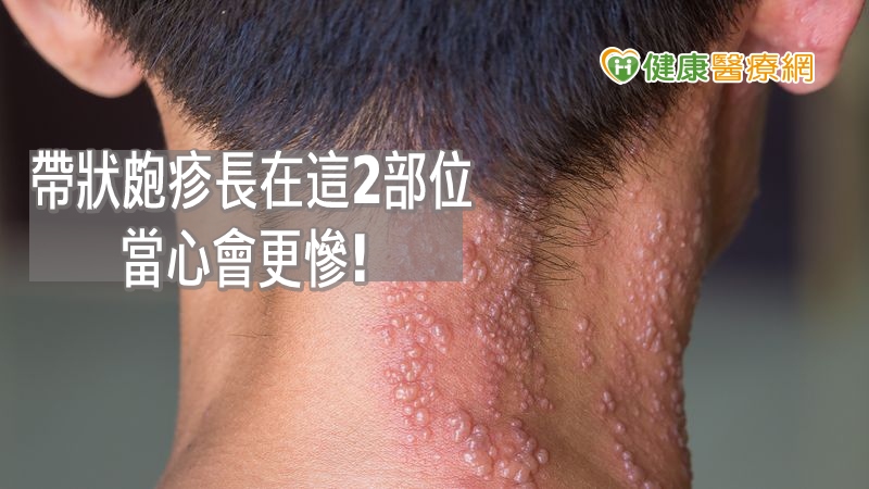 如帶狀皰疹長在頭頸部，可能會伴隨蜂窩性組織炎、顏面神經麻痺、腦膜炎或影響聽力、視力；長在生殖器可能會影響排泄功能，恐無法順利排便排尿，因此，若出現症狀應儘早就醫、治療。