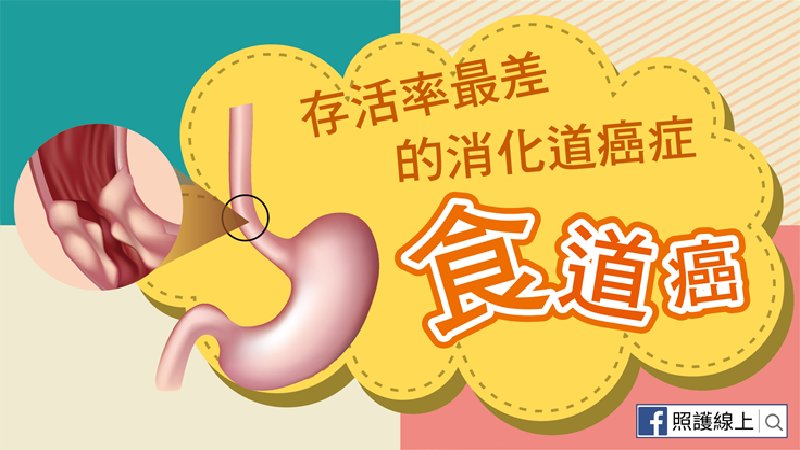 存活率最差的消化道癌症 – 食道癌（懶人包）