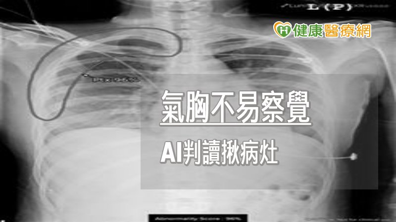 氣胸病灶不易察覺，人工智慧（AI）輔助判讀系統的應用，讓臨床醫師輕鬆又容易診斷出病人有氣胸現象，並馬上做出適當的醫療處置，提升患者治療的即時性。