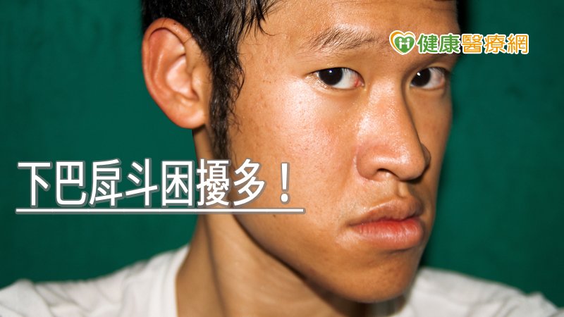 下巴戽斗困擾多 正顎手術挽回顏面及健康 健康醫療網 健康養生新聞資訊網路媒體