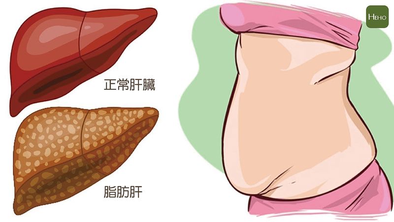 肝癌原因不只是「慢性肝炎」！醫：再不減肥你就是高風險族群