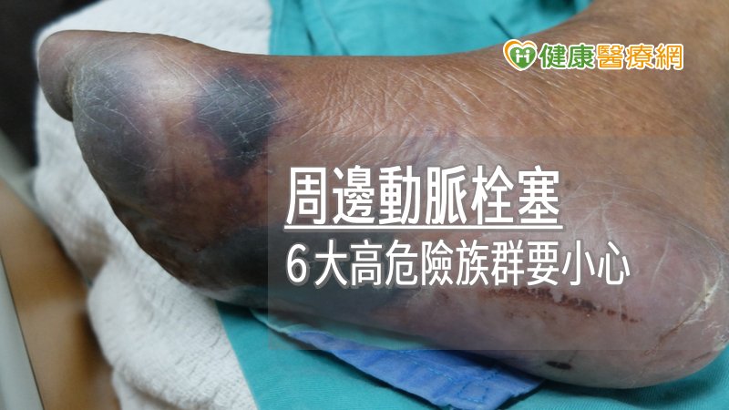 周邊動脈栓塞患者初期可能會有下肢間歇性跛行現象，到了中晚期，即便短距離走路也容易腳痛，且平時也有痠麻和疼痛感，皮膚則會變紫或變黑。