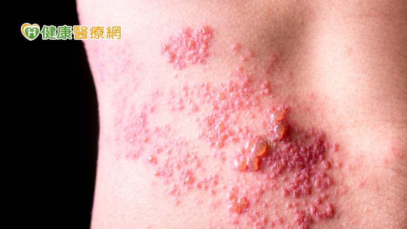 帶狀疱疹目前雖然已有藥物可以治療，越早用藥、發作時間越短也越快痊癒，不過帶狀疱疹發作的部位不一，引起的症狀也不同，很難早期發現、早期用藥。