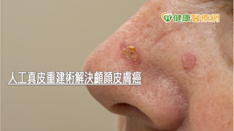皮膚癌新術式　成果獲登國際期刊
