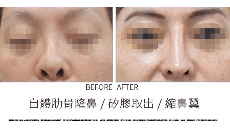 一定要用自己的肋骨嗎？用假體不行嗎？或是異體肋骨呢？