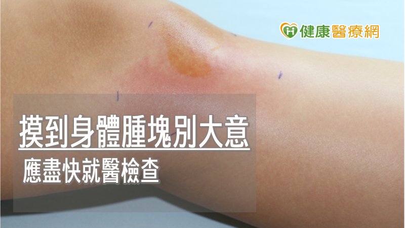 惡性肉瘤初期無感　出現痛覺恐已成癌