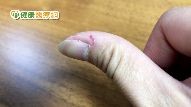 出現指甲倒刺並非缺乏維生素，也不代表身體出現異常狀況，陳逸懃醫師強調，網路上有許多危言聳聽的農場文章，多數缺乏專家背書，不足以採信。原因非常單純，就是因為指甲與皮膚太乾燥而已。