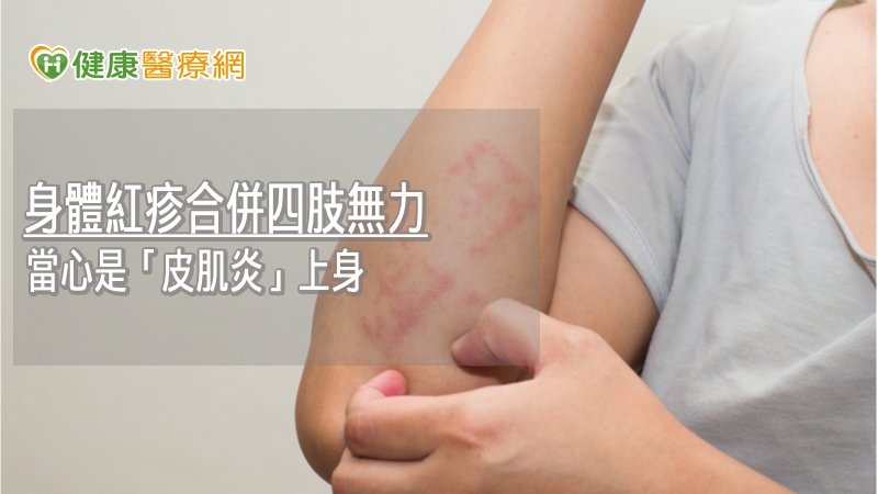皮肌炎屬於全身性自體免疫疾病中相對少見的疾病，遠少於全身性紅斑狼瘡，因此一般民眾對此疾病非常不熟悉。