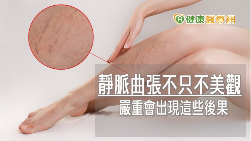 醫師提醒，靜脈曲張並不只是影響腿部外觀而已，其會導致靜脈血液無法順利回流，嚴重可能會有血栓等致命併發症，不可小覷。