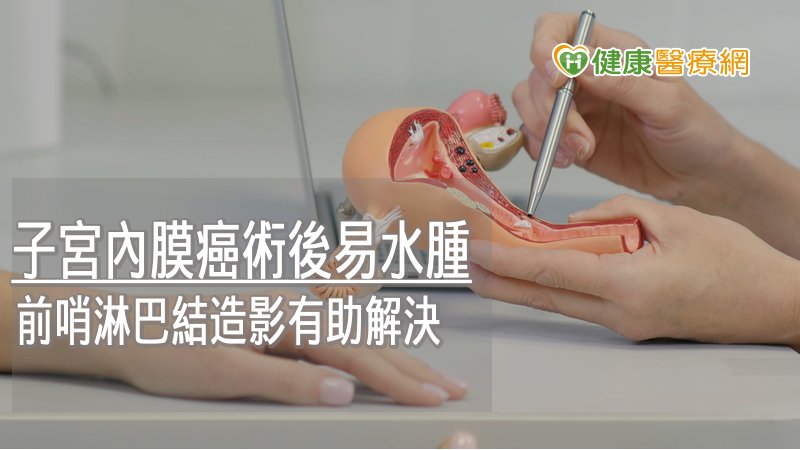 子宮內膜癌術後易水腫　前哨淋巴結造影有助解決