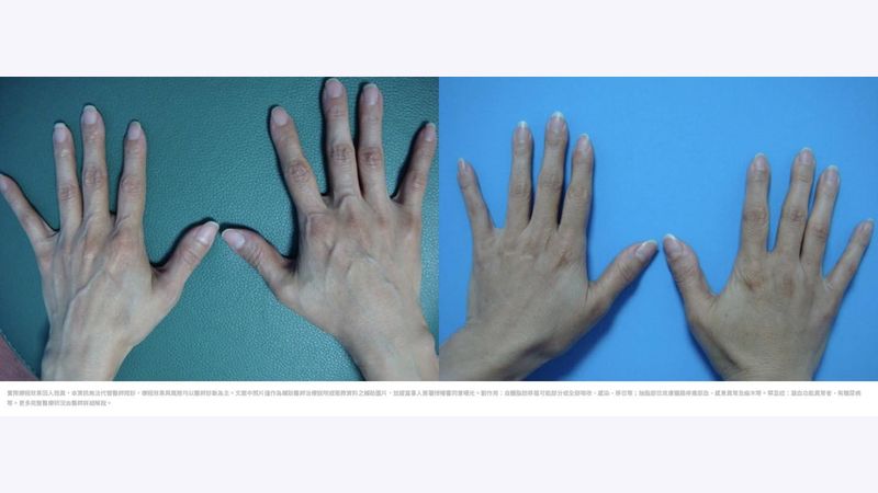出手就顯老 談雞爪手的改善 健康醫療網 健康養生新聞資訊網路媒體 出手就顯老 談雞爪手的改善 健康醫療網 健康養生新聞資訊網路媒體