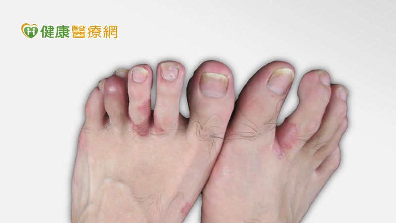 「目前乾癬性關節炎的治療上，希望儘早從乾癬性關節炎患者中，診斷出容易演變成快速關節破壞的族群，給予適當的治療，而非僅使用非類固醇消炎止痛藥。」