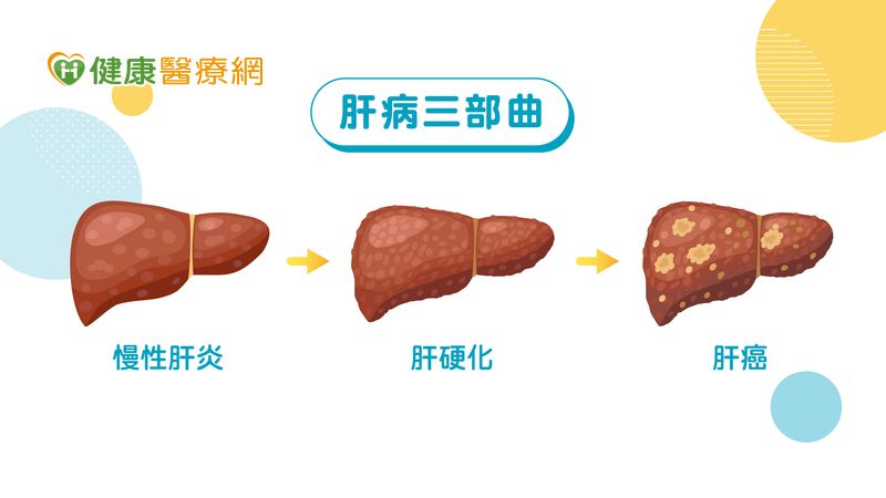 B肝帶原是隱形的殺手？　罹肝癌風險高出150倍