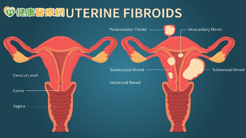 子宮肌瘤大於３公分　當心腹痛、胎位不正、早產、胎盤早期剝離