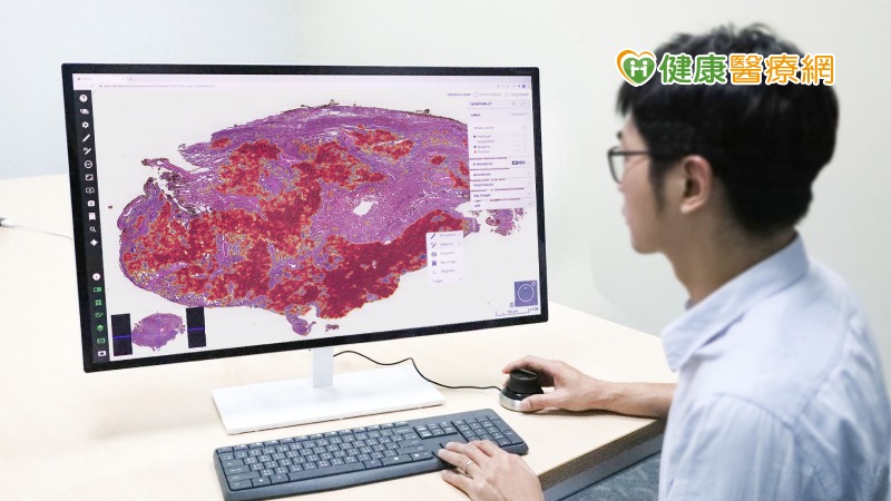 AI輔助判讀肺癌數位病理影像新突破　北醫大團隊研究登國際知名期刊