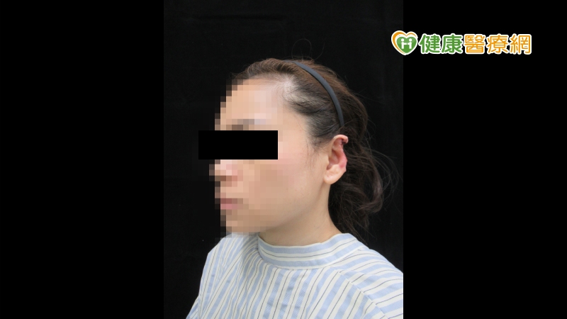 呂明川表示，林小姐是4個多月前來診，缺了一大塊的耳廓經止血消毒後是沒什麼大礙，對生活也沒太大影響，但對外觀是一大打擊，一般人的心理可能難以接受，尤其是女生。林小姐對此也無法接受，也因為缺塊的耳朵已經不復得，無法進行顯微手術再植復原，只好進行斷耳再造。