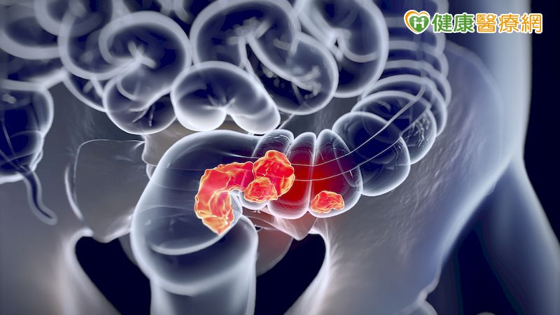 腸癌內視鏡檢查新突破！　AI輔助診斷病灶無所遁形