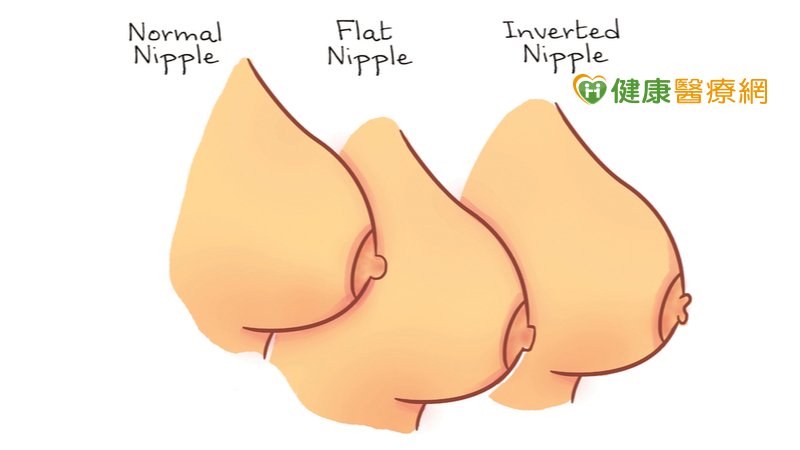 婦女若出現乳頭凹陷，有任何可疑的異常都應進行切片檢查，若沒有異常證據，最好是每年定期追蹤。