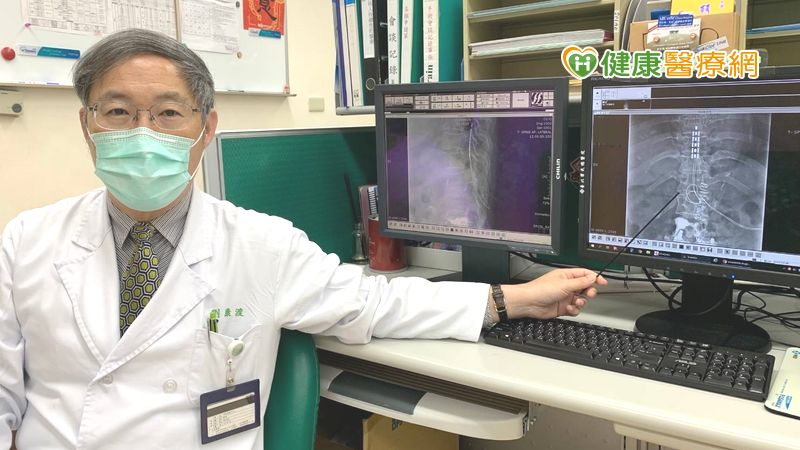 劉康渡主任解釋，脊髓刺激療法是一種神經調控的療法，將一個電極線，植入脊髓硬膜的外腔，刺激中樞脊髓背部的神經纖維，調節傳導至腦部的不正常訊號，達到控制疼痛的目的。
