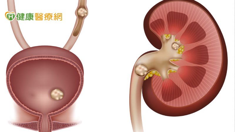 若有血尿等尿檢異常或不明原因腎功能減退，應該要接受進一步的檢查，萬一是結石也要盡快處理。