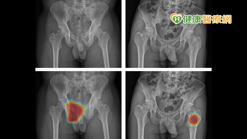 長庚AI輔助揪出骨盆骨折點　各種病灶都無所遁形