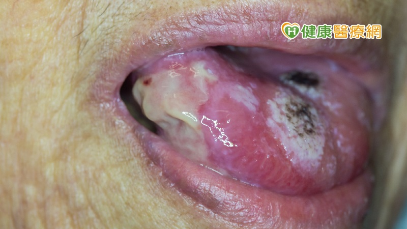 台灣口腔癌多因「1習慣」所致！　高風險群應定期篩檢