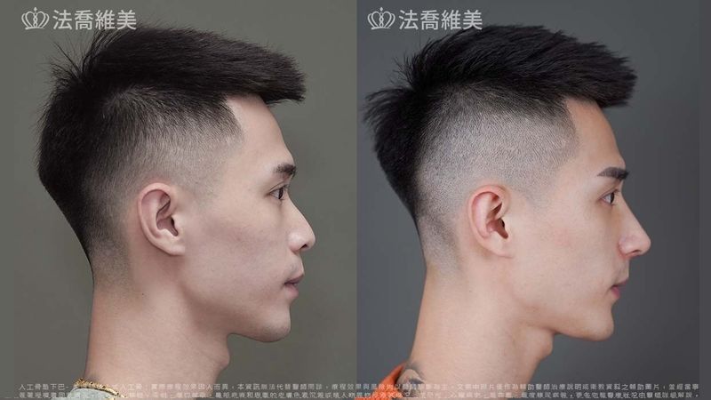 臨床上有許多人希望鼻子愈高愈好，也會拿著明星的照片，要求醫師打造一樣的鼻型，事實上完美的鼻型必須依據個人臉型量身訂定，並不只是把填充物放進鼻子裡就會好看了。《 照片素材來源：https://www.facharming.com/cases/4540 》