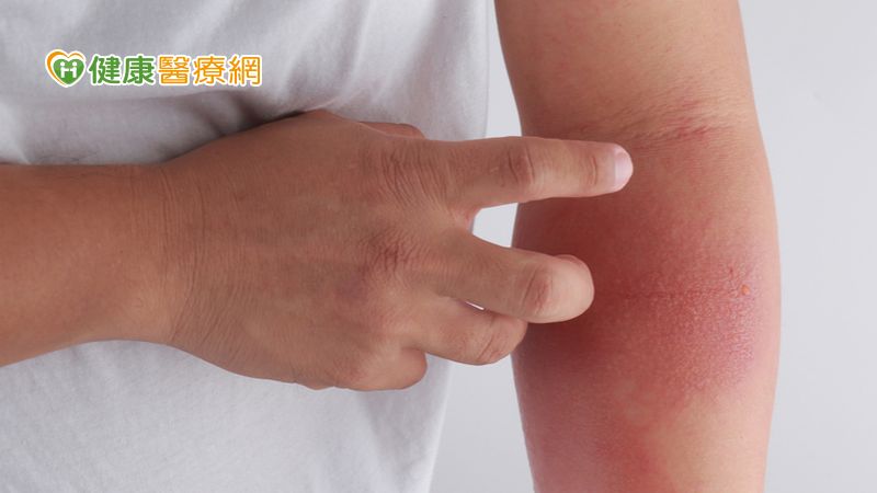 台灣疫情升溫，許多患者疫情期間不敢就醫治療。對此，黃毓惠醫師強調，異位性皮膚炎需要長期的穩定治療，由於疾病不會斷根，若任意停藥，就會再復發及惡化。