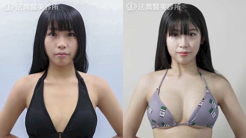 上胸沒肉想隆乳手術該怎麼選擇？邱浚彥醫師曝關鍵