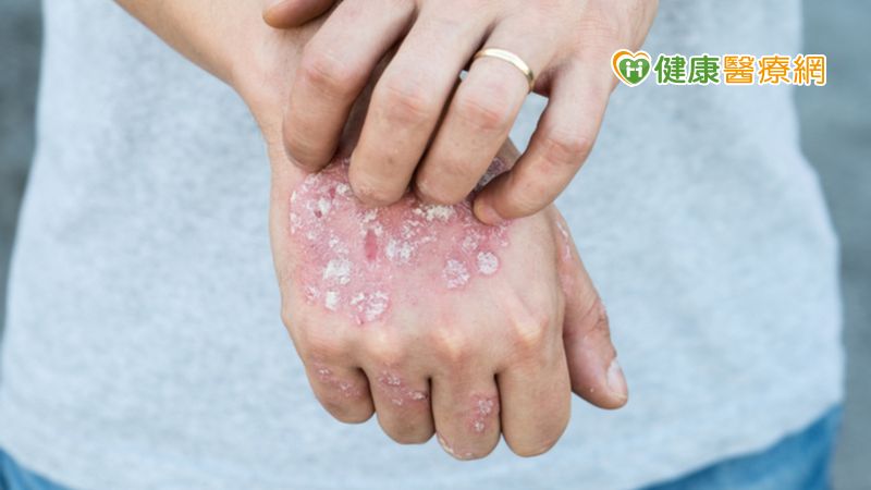 乾癬患者因免疫系統失調，造成發炎因子流竄全身，使皮膚出現斑塊型皮屑，較嚴重患者更會走到哪、皮屑掉到哪，對求學、求職及人際關係影響甚鉅。