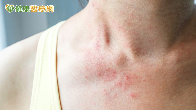 大部分紅疹位置出現在衣服無覆蓋的部位，包含頸部、手臂等部位，初步診斷為「刺激性接觸性皮膚炎」，且不具有傳染性，建議病人以弱水流來淋浴，反覆沖洗身體刺癢部位，以減緩皮膚刺激程度