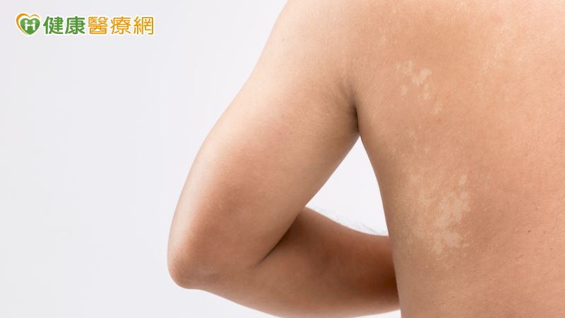 天熱會造成汗斑、白斑、蕁麻疹？　皮膚科破解迷思