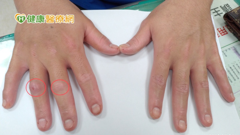 乾癬病友手指變香腸　竟是關節炎可能找上門