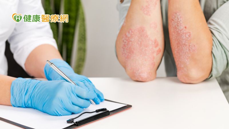世界乾癬日：兼顧皮表乾癬與併發症　落實全方位健康管理
