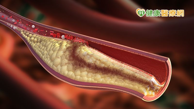 高血脂患者當「心」!　這些數值高恐增新冠肺炎重症風險