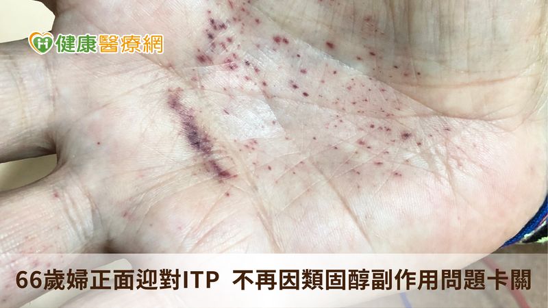 66歲婦正面迎對ITP　不再因類固醇副作用問題卡關