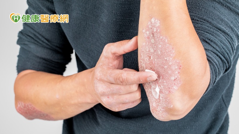 乾癬擦藥、吃藥沒改善？　生物製劑成治療新利器   