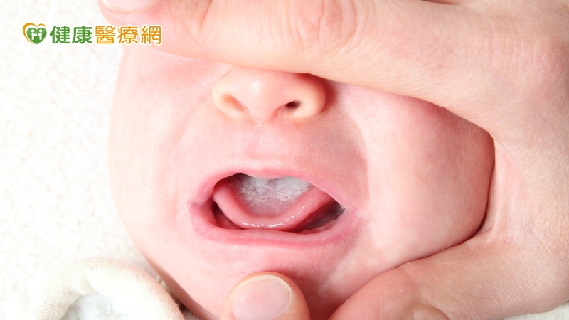 寶寶嘴巴出現白點或血點　小心念珠菌感染引發「鵝口瘡」
