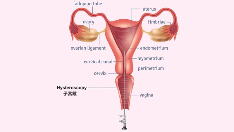 子宮鏡—婦產科醫師的第三隻眼