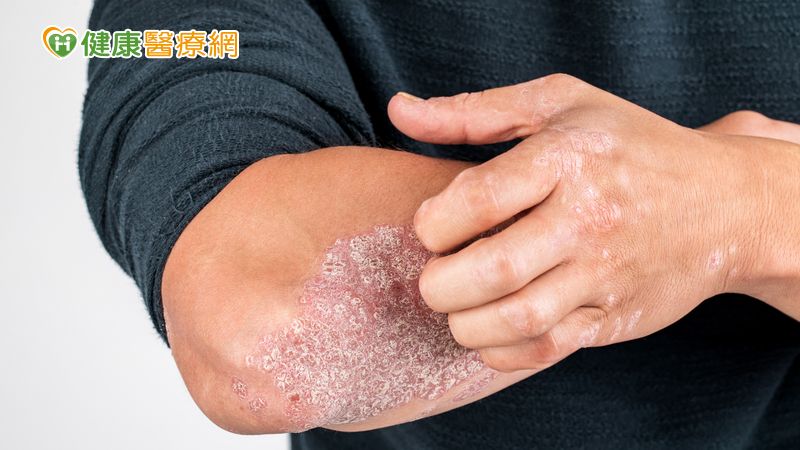 現階段在乾癬治療中，除了外用藥膏、口服藥物與照光治療，也有生物製劑可做為治療選擇，不僅能抑制體內發炎反應，藥物發揮作用快速且副作用相較傳統藥物也較低，呼籲患者面對乾癬治療時務必持續與醫師做討論，在良好的醫病溝通下找到最合適的治療方式。