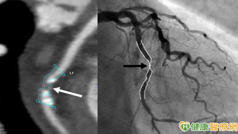 一60歲男性患者，近兩個月胸痛不適、心電圖異常，做冠狀動脈電腦斷層血管攝影 (CCTA) 呈現左迴旋支動脈有鈣化和嚴重狹窄 (狹窄直徑 &gt; 70%) (白箭號)，經心導管檢查證實(黑箭號)和置放支架治療後，成功避免發生心肌梗塞