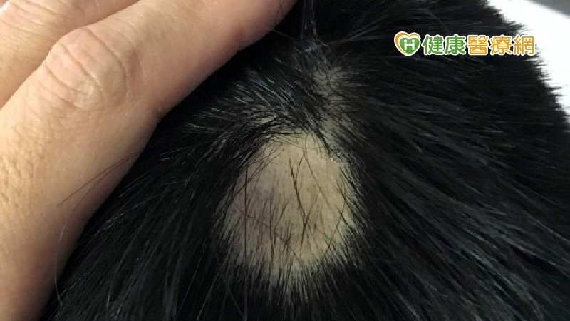 皮膚科李瑜芬醫師指出，壓力或免疫系統失調，免疫細胞攻擊自身的毛囊就可能導致落髮。