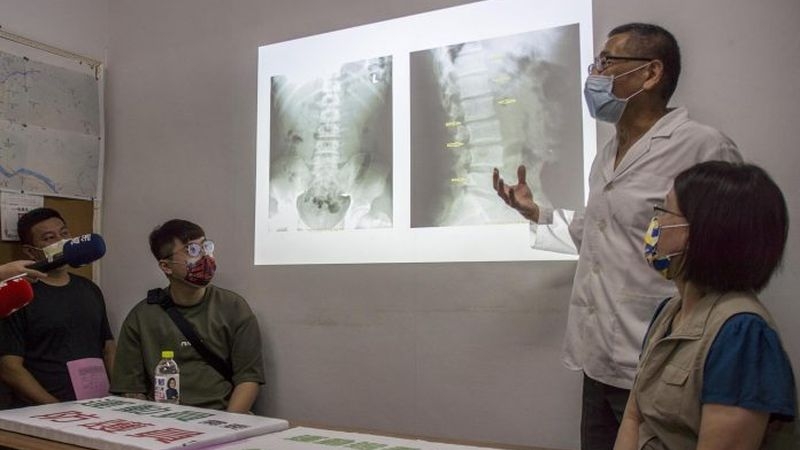 一名14歲舉重選手出現腰椎體輕度壓迫性塌陷及長出骨刺，疑因出現運動傷害。（中華新聞雲／記者黃俊昇攝）