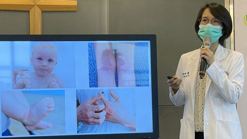 異位性皮膚炎每天做好乳液保濕等基本功，是改善膚質、減少濕疹發作的重要步驟。（中華新聞雲／記者鄭錦晴攝）