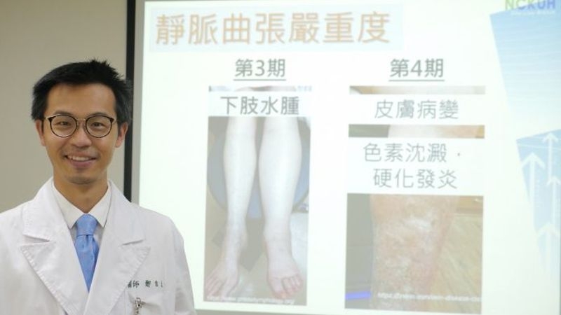 醫師鄭吉夫提醒，久站、家族遺傳等是靜脈曲張高風險族群。（中華新聞雲提供）