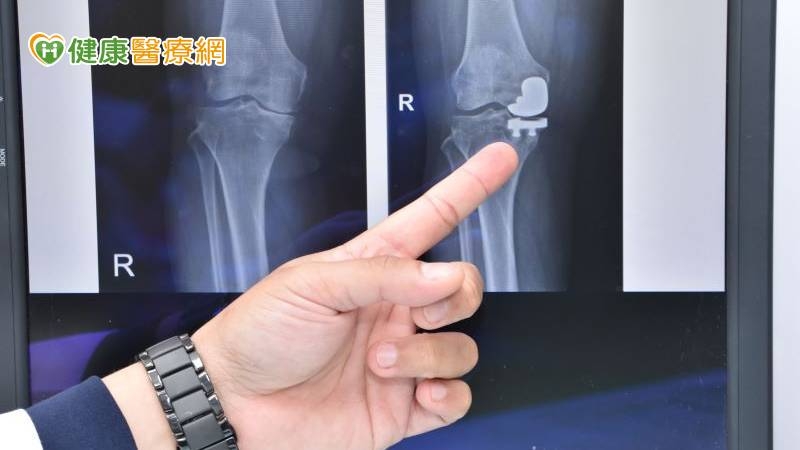 阿嬤經半套人工關節置換後，關節腔再度有了空間。