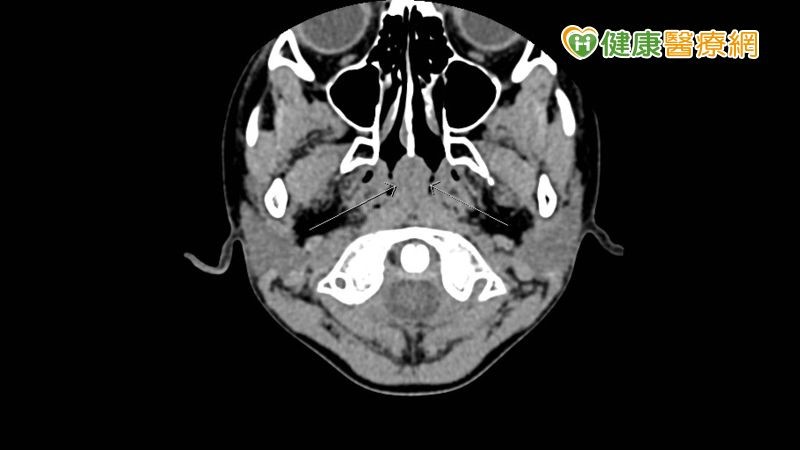 6歲男童鼻咽部出現疑似腫塊。（圖／翻攝自健康醫療網）