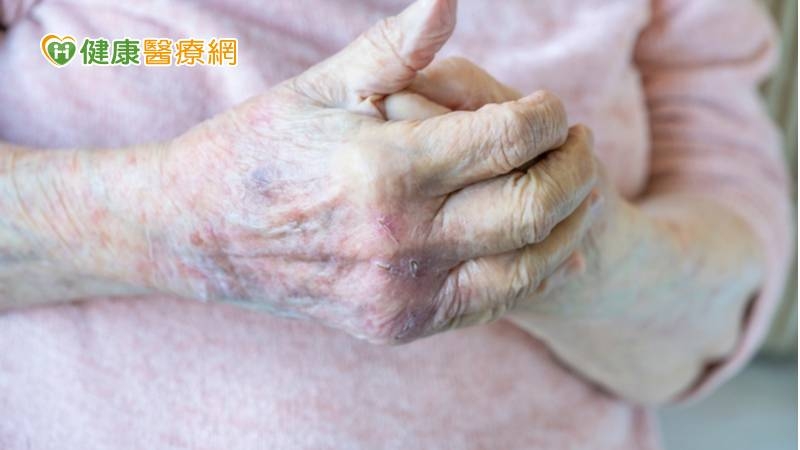 家中長輩原本有皮膚癢的問題，梅雨季突然加重，可觀察長輩的手指、手掌、腳趾與腳掌的兩側，如果長出數顆比「西米露」小的水泡，那可能就是汗皰疹在作怪。