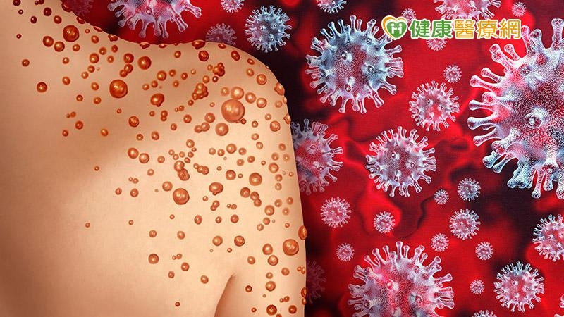 英國衛生官員6日回報新增77例猴痘病例，使全英病例總數突破300例。