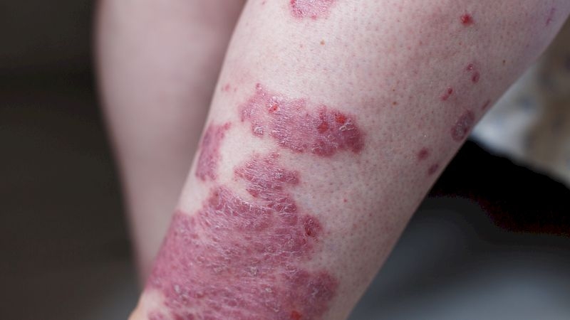 帶狀皰疹就是俗稱的皮蛇或飛蛇，與水痘病毒（ Varicella-Zoster Virus, HZV）有關，好發於年長著與慢性病或免疫力低的患者